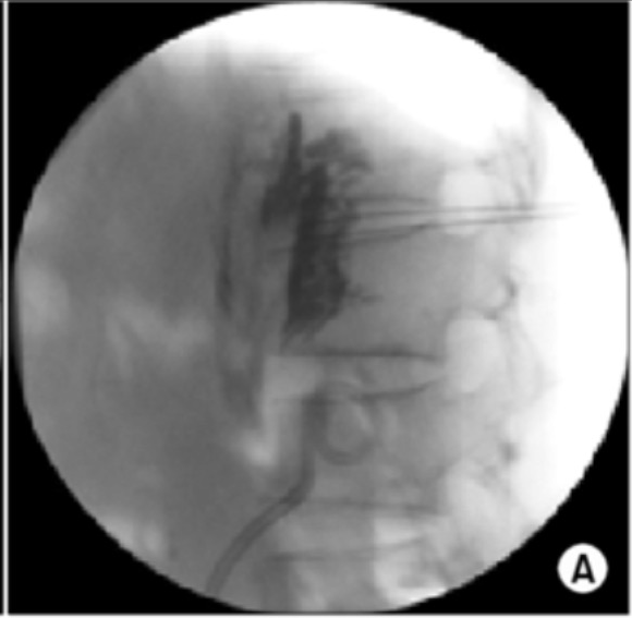 Chemical Neurolysis Spine specialist doctor in surat Spine