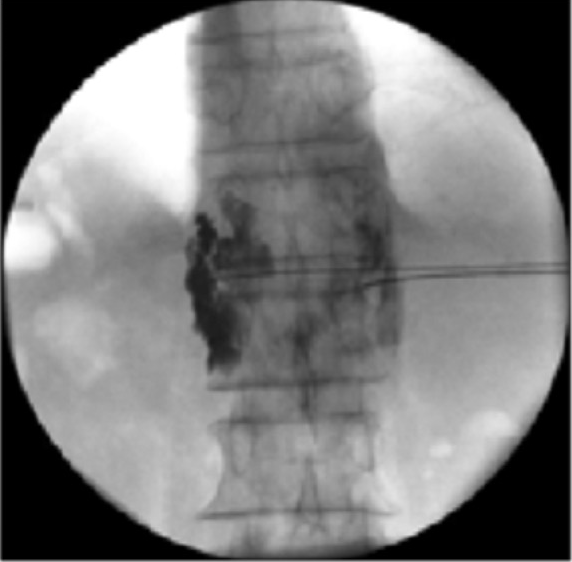 Chemical Neurolysis spine specialist doctor in Surat Dr.shishir