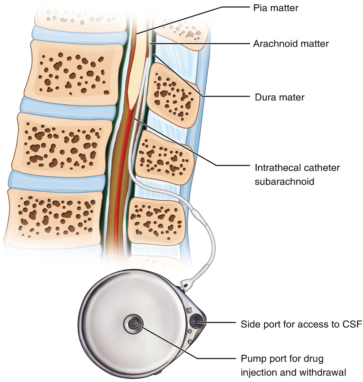 Intrathecal Drug Delivery System Spine Specialist Doctor In Surat 